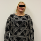 Compare Before & After Photos of _procedure_photos.phpGastric Balloon Treatment