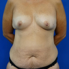 Compare Before & After Photos of _procedure_photos.phpMommy Makeover