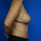 Compare Before & After Photos of _procedure_photos.phpMommy Makeover