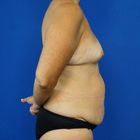 Compare Before & After Photos of _procedure_photos.phpMommy Makeover