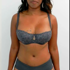 Compare Before & After Photos of _procedure_photos.phpMommy Makeover