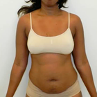 Compare Before & After Photos of _procedure_photos.phpMommy Makeover