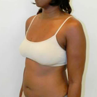 Compare Before & After Photos of _procedure_photos.phpMommy Makeover