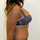 Compare Before & After Photos of _procedure_photos.phpMommy Makeover