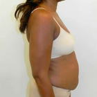 Compare Before & After Photos of _procedure_photos.phpMommy Makeover