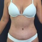 Compare Before & After Photos of _procedure_photos.phpMommy Makeover