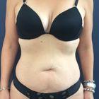 Compare Before & After Photos of _procedure_photos.phpMommy Makeover