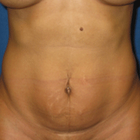 Compare Before & After Photos of _procedure_photos.phpMommy Makeover