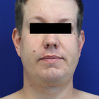 Compare Before & After Photos of _procedure_photos.phpNeck Lift