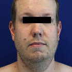 Compare Before & After Photos of _procedure_photos.phpNeck Lift