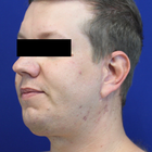 Compare Before & After Photos of _procedure_photos.phpNeck Lift