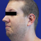 Compare Before & After Photos of _procedure_photos.phpNeck Lift