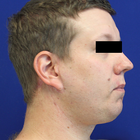 Compare Before & After Photos of _procedure_photos.phpNeck Lift