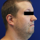 Compare Before & After Photos of _procedure_photos.phpNeck Lift