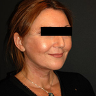 Compare Before & After Photos of _procedure_photos.phpNeck Lift