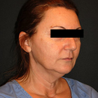 Compare Before & After Photos of _procedure_photos.phpNeck Lift