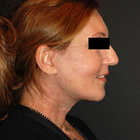 Compare Before & After Photos of _procedure_photos.phpNeck Lift