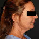 Compare Before & After Photos of _procedure_photos.phpNeck Lift