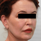Compare Before & After Photos of _procedure_photos.phpNeck Lift