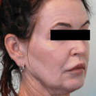 Compare Before & After Photos of _procedure_photos.phpNeck Lift