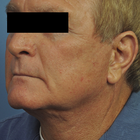 Compare Before & After Photos of _procedure_photos.phpNeck Lift