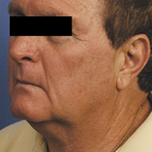 Compare Before & After Photos of _procedure_photos.phpNeck Lift