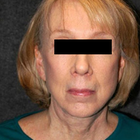 Compare Before & After Photos of _procedure_photos.phpNeck Lift