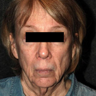 Compare Before & After Photos of _procedure_photos.phpNeck Lift