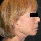 Compare Before & After Photos of _procedure_photos.phpNeck Lift