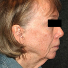 Compare Before & After Photos of _procedure_photos.phpNeck Lift