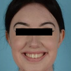Compare Before & After Photos of _procedure_photos.phpChin Augmentation
