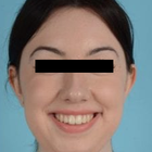 Compare Before & After Photos of _procedure_photos.phpChin Augmentation
