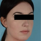 Compare Before & After Photos of _procedure_photos.phpChin Augmentation