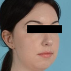 Compare Before & After Photos of _procedure_photos.phpChin Augmentation