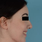 Compare Before & After Photos of _procedure_photos.phpChin Augmentation
