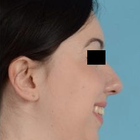 Compare Before & After Photos of _procedure_photos.phpChin Augmentation