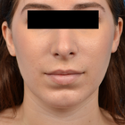 Compare Before & After Photos of _procedure_photos.phpChin Augmentation