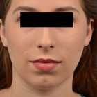 Compare Before & After Photos of _procedure_photos.phpChin Augmentation