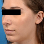 Compare Before & After Photos of _procedure_photos.phpChin Augmentation