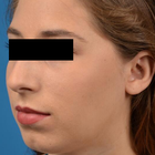Compare Before & After Photos of _procedure_photos.phpChin Augmentation