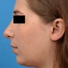 Compare Before & After Photos of _procedure_photos.phpChin Augmentation