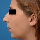 Compare Before & After Photos of _procedure_photos.phpChin Augmentation