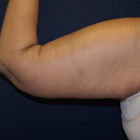 Compare Before & After Photos of _procedure_photos.phpArm Lift