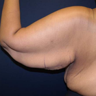 Compare Before & After Photos of _procedure_photos.phpArm Lift