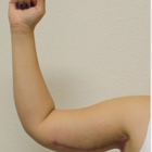 Compare Before & After Photos of _procedure_photos.phpArm Lift