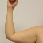 Compare Before & After Photos of _procedure_photos.phpArm Lift