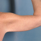 Compare Before & After Photos of _procedure_photos.phpArm Lift