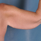 Compare Before & After Photos of _procedure_photos.phpArm Lift
