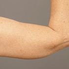 Compare Before & After Photos of _procedure_photos.phpArm Lift