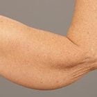 Compare Before & After Photos of _procedure_photos.phpArm Lift